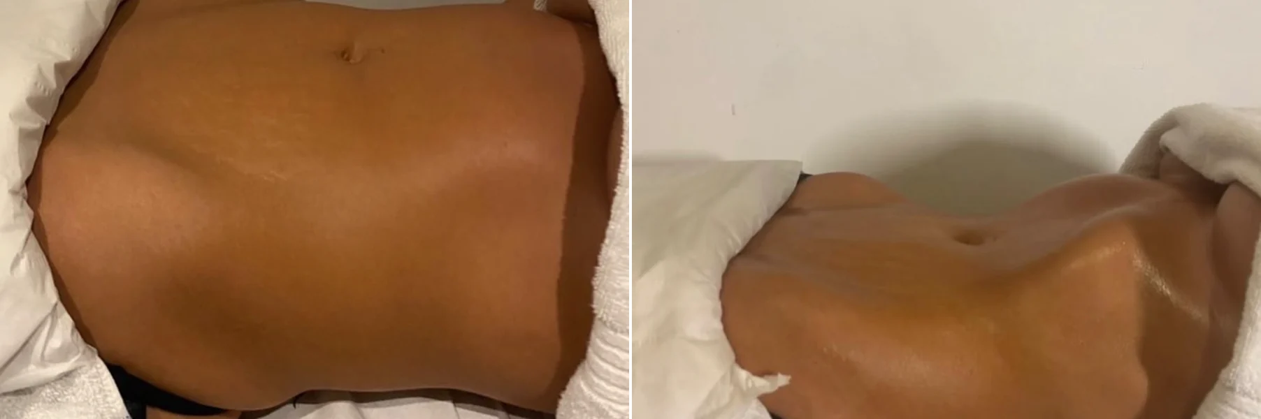 Abdomen before and after a single lymphatic drainage session