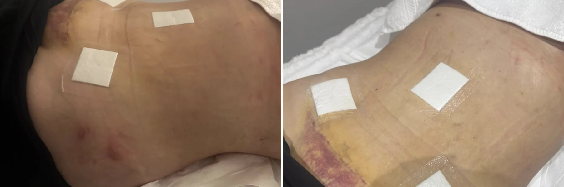 Abdomen before and after post surgery lymphatic drainage