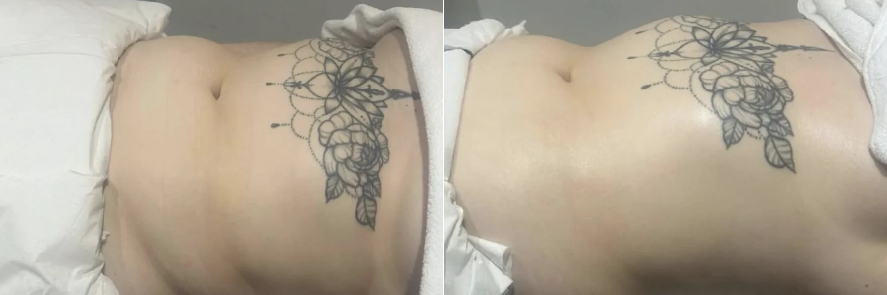 Stomach before and after lymphatic drainage