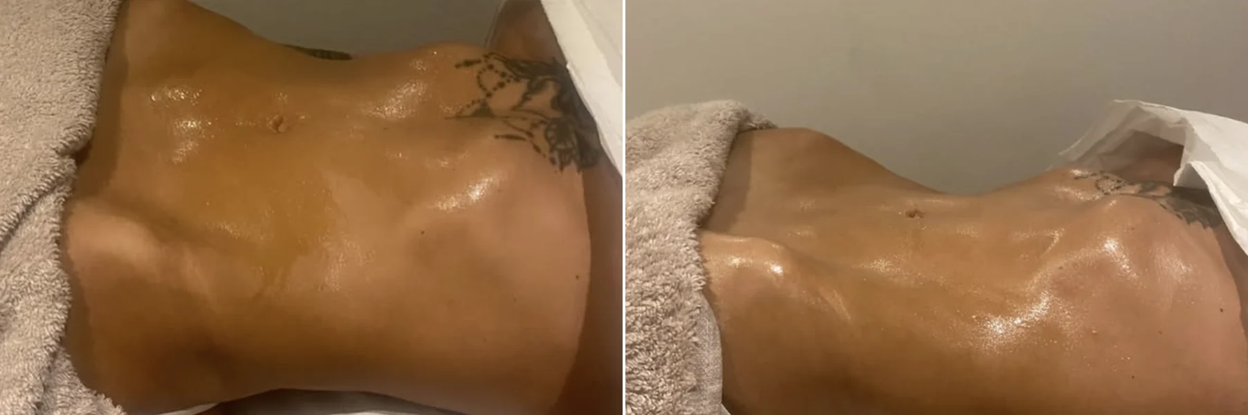 Waist before and after lymphatic drainage