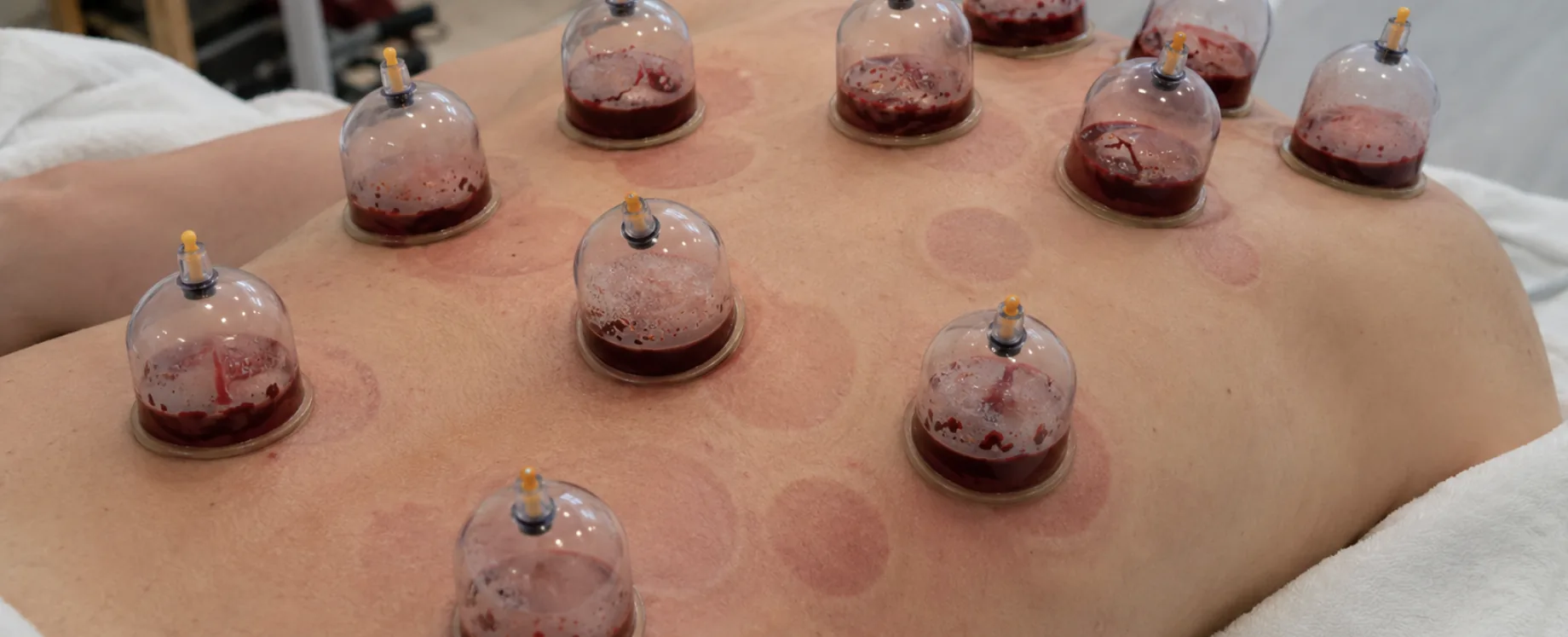 Cupping therapy session at Liverpool Lymphatic Drainage in Huyton