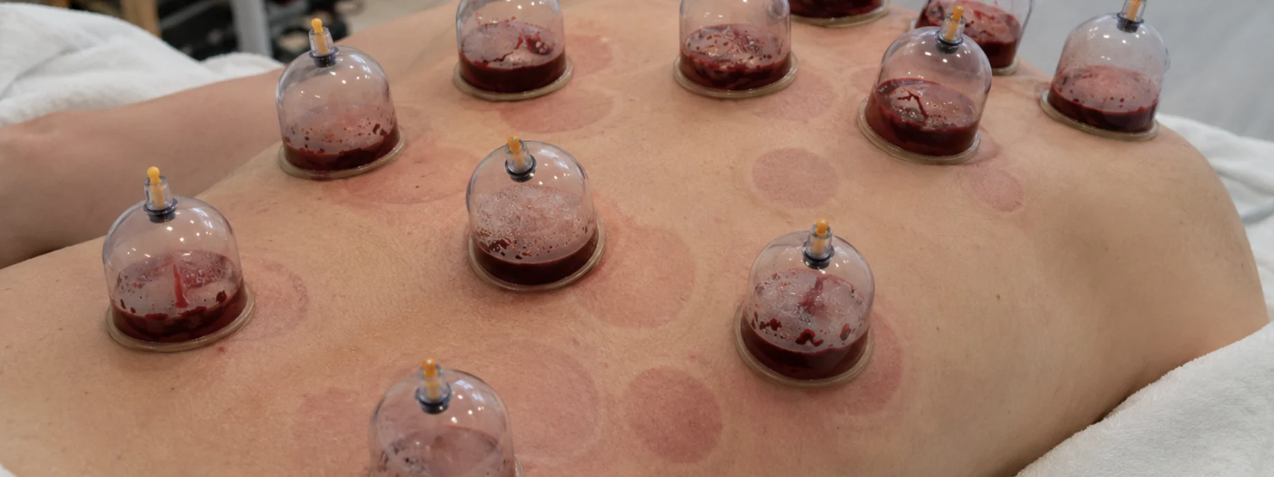 Cupping therapy session at Liverpool Lymphatic Drainage