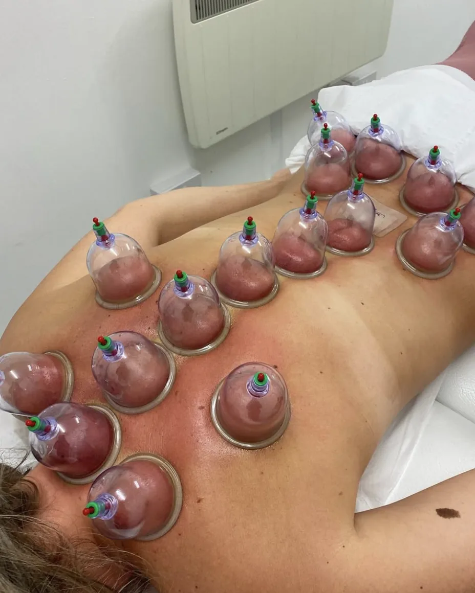 Cups placed across the shoulders and upper back