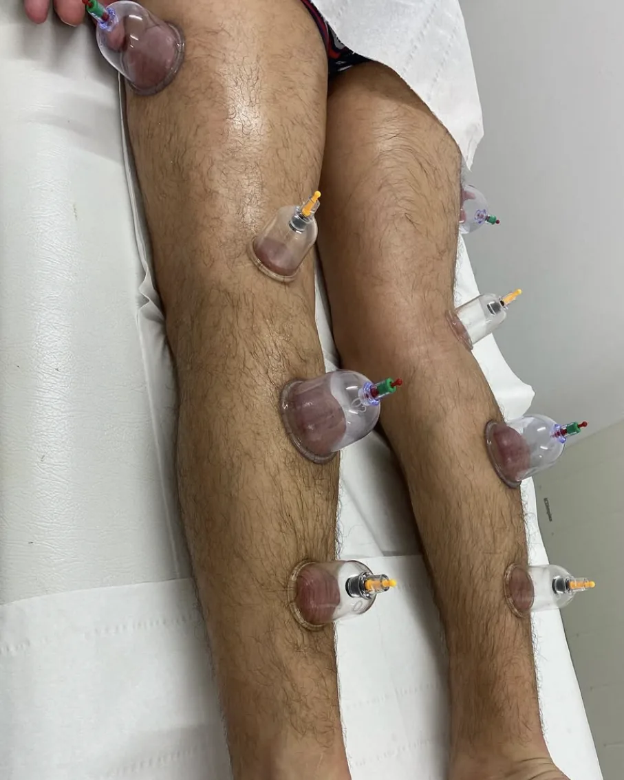 Cupping applied to the back of the legs