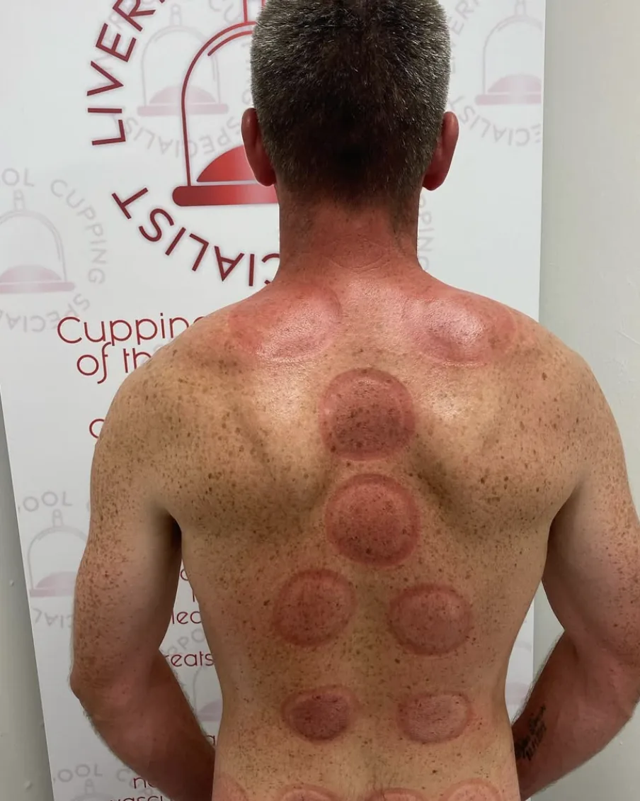 Cupping marks across a client's back after treatment