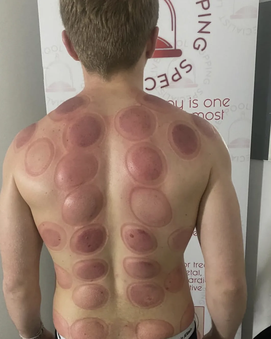 Cupping marks photographed against the Liverpool Lymphatic Drainage banner