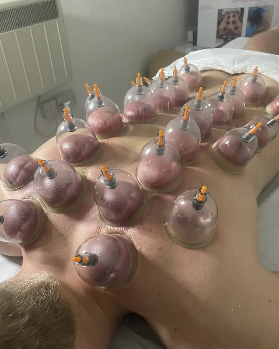 Cupping treatment demonstration during training at Liverpool Lymphatic Drainage